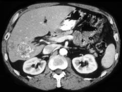 Hepatoma - CTisus CT Scan