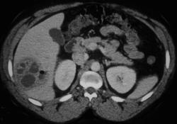 Liver Abscess - CTisus CT Scan