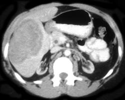 Hepatoma - CTisus CT Scan