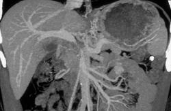 Pancreatic Cancer Encases Portal Vein W/ Collaterals - CTisus CT Scan