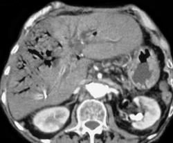 Air in Portal Venous System With Liver Necrosis - CTisus CT Scan