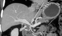 Stenosis of PV/SMV Confluence in Liver Transplant Recipient - CTisus CT Scan