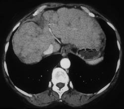 Cirrhosis - CTisus CT Scan