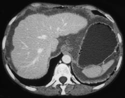 Cirrhosis and Ascites - CTisus CT Scan