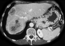 Hepatoma - CTisus CT Scan