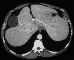 Biloma Post Hepatic Resection - CTisus CT Scan