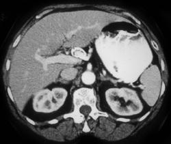 Hepatic Artery Aneurysm - CTisus CT Scan