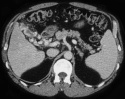 Gallbladder Varices - CTisus CT Scan