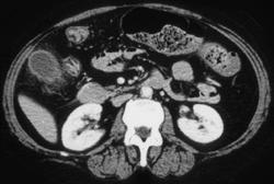 Acute Cholecystitis - CTisus CT Scan