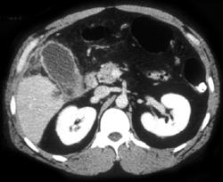 Acute Cholecystitis - CTisus CT Scan