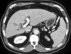 Cholangiocarcinoma - CTisus CT Scan