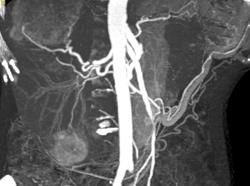 Multifocal Hepatoma - CTisus CT Scan