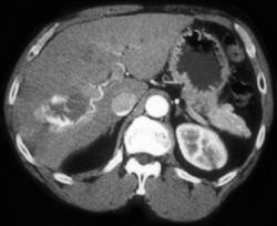 Atypical Hemangioma - CTisus CT Scan