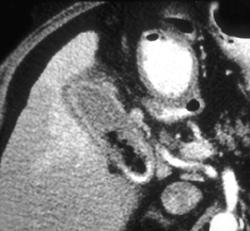 Gallbladder Abscess - CTisus CT Scan