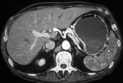 Hepatic Artery Aneurysm - CTisus CT Scan