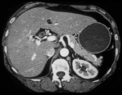 Thickening Common Bile Duct in Patient With Cholangitis Sclerosing - CTisus CT Scan