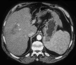 Liver Metastases - CTisus CT Scan