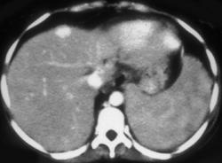 Bacillary Angiomatosis With Vascular Lesion - CTisus CT Scan
