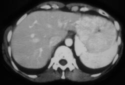 Focal Nodular Hyperplasia - CTisus CT Scan