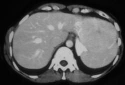 Focal Nodular Hyperplasia - CTisus CT Scan