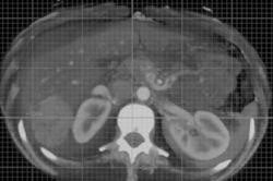 Hepatic Adenoma - CTisus CT Scan