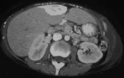 Flow Changes With Hot Spot Due to SVC Occlusion - CTisus CT Scan