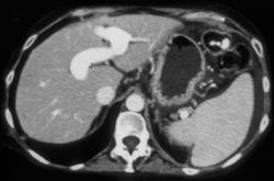 Dilated Unbilical Veins - CTisus CT Scan