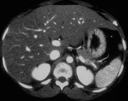 Fatty Liver - CTisus CT Scan