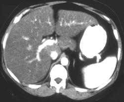 Fatty Liver - CTisus CT Scan