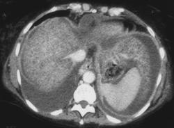 Fatty Liver - CTisus CT Scan