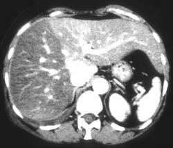 Fatty Liver (focal) - CTisus CT Scan