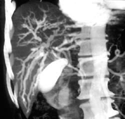 Klatskin Tumor - CTisus CT Scan