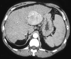 Hepatoma - CTisus CT Scan