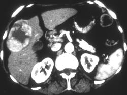 Hepatoma - CTisus CT Scan