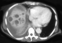 Multiple Liver Abscesses - CTisus CT Scan