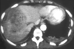 Liver Mass- Hepatoma - CTisus CT Scan