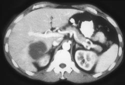 Liver Abscess - CTisus CT Scan