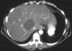 Liver Abscess - CTisus CT Scan