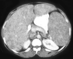 Sarcoidosis - CTisus CT Scan