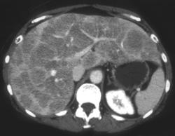 Widespread Metastases - CTisus CT Scan