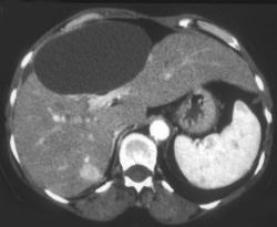 Biloma Plus Hemangioma (right Lobe) - CTisus CT Scan