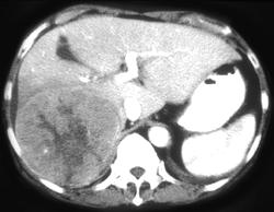 Hepatoma - CTisus CT Scan