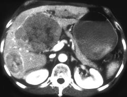 Multifocal Hepatoma - CTisus CT Scan