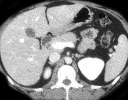 Multiple Focal Nodular Hyperplasias (FNHs) - CTisus CT Scan