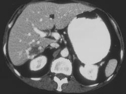 Hemangiomas - CTisus CT Scan