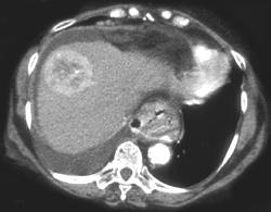 Hepatoma - CTisus CT Scan