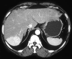 Focal Nodular Hyperplasia - CTisus CT Scan