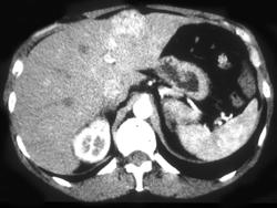 Hepatoma - CTisus CT Scan