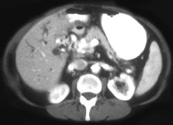 Portal Vein Thrombosis With Cavernous Transformation of the Portal Vein - CTisus CT Scan