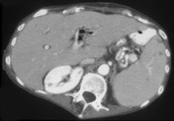 Infected Clot in Portal Vein - CTisus CT Scan